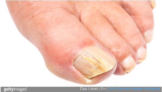 Mycose du gros orteil, ongles incarnés ou verrues : le podologue soulage tous ces problèmes de pieds.