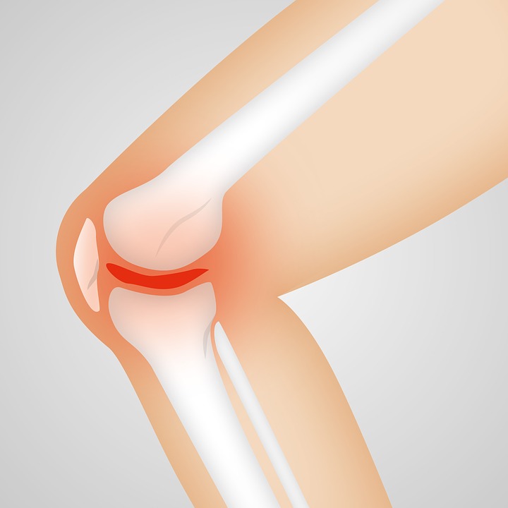 Comment soigner l’arthrose du genou ?